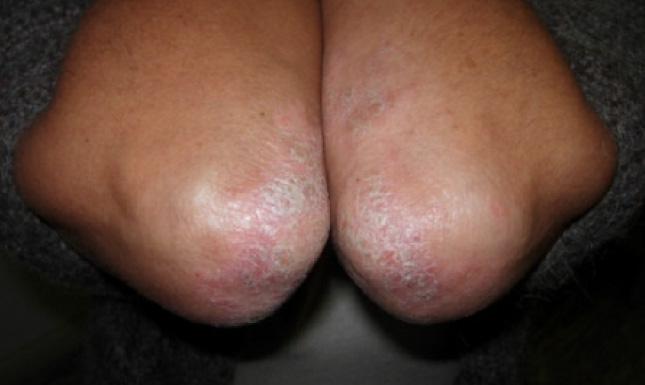 Psoriasi al gomito - Durante il trattamento, 3 mesi